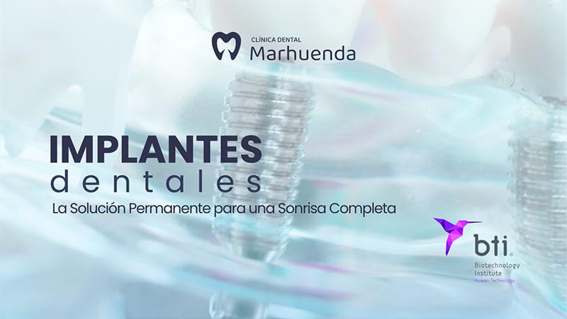 Implantes Dentales: La Solución Permanente para una Sonrisa Completa