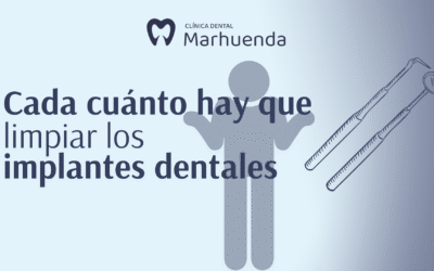 Cada cuánto hay que limpiar los implantes dentales