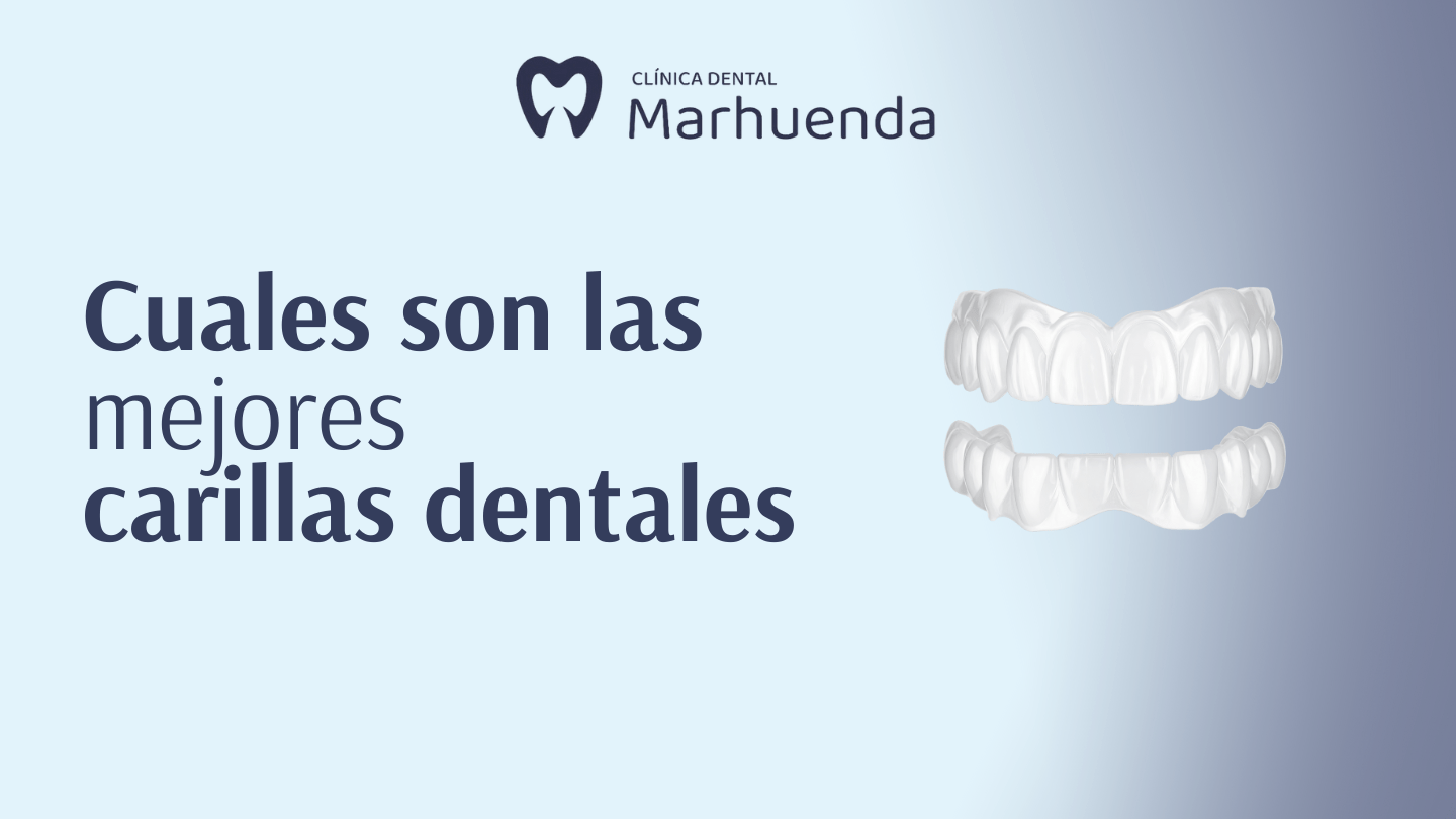 cuales son las mejores carillas dentales