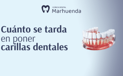 Cuánto se tarda en poner carillas dentales​