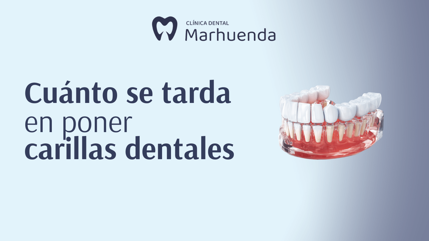 cuanto se tarda en poner carillas dentales