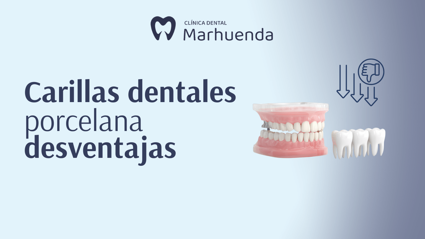 carillas dentales porcelana desventajas​