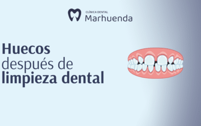 Huecos después de limpieza dental