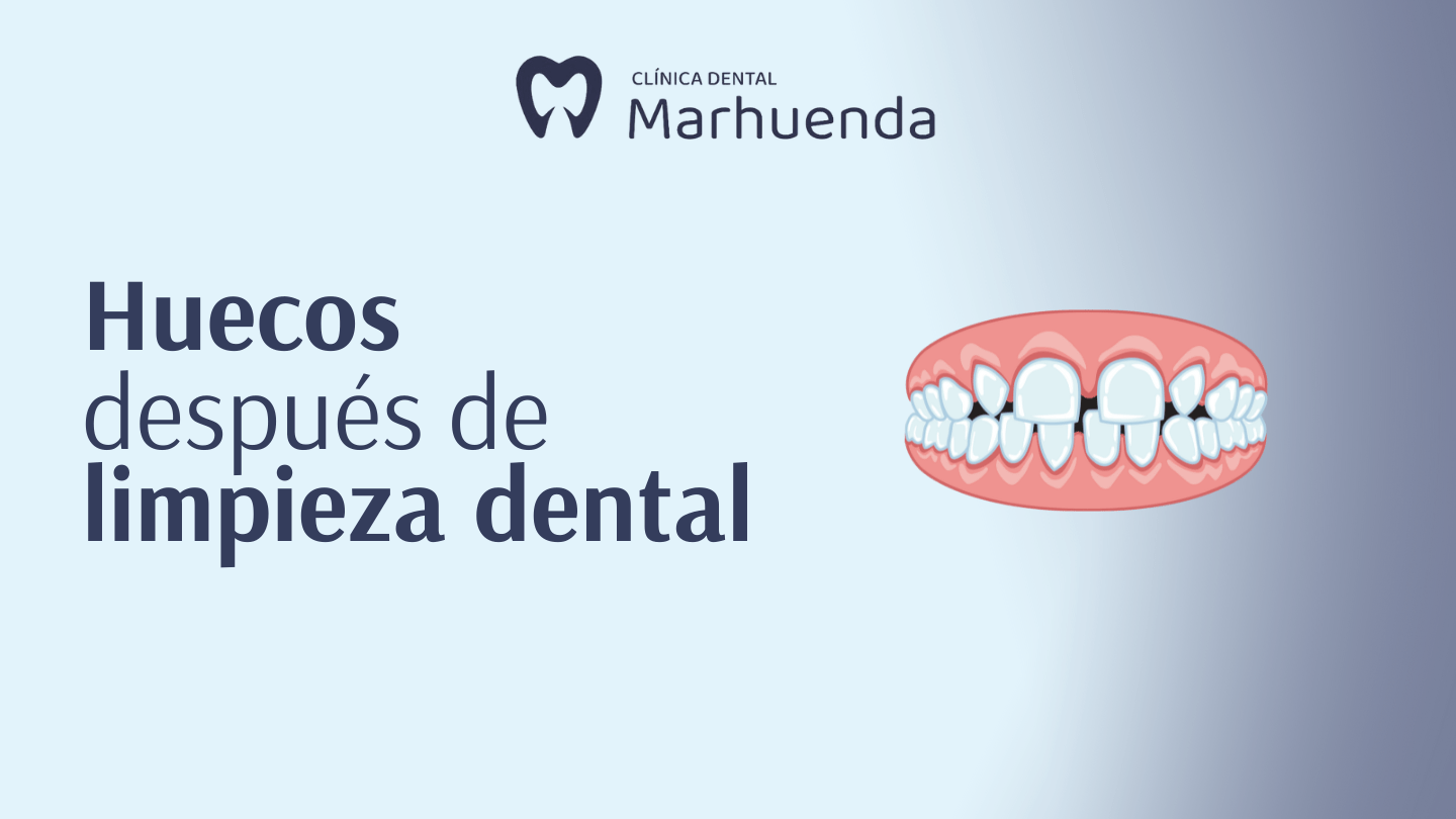 huecos despues de limpieza dental