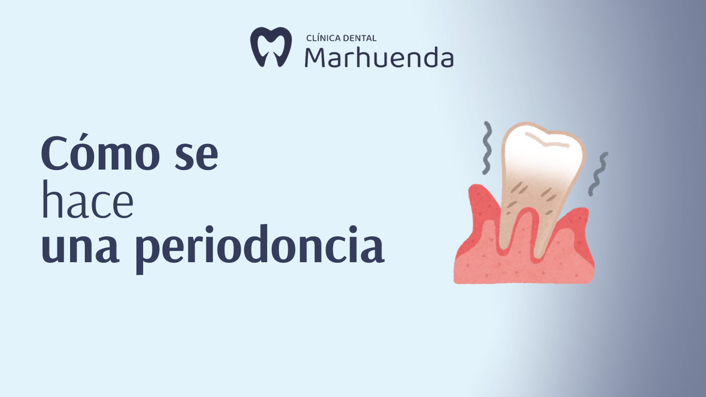 como se hace una periodoncia