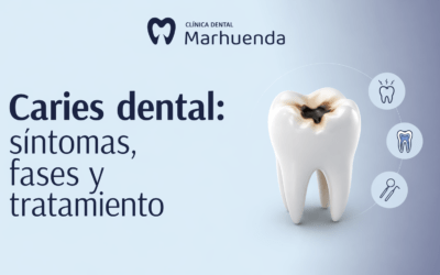 Caries dental: síntomas, fases y tratamiento