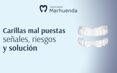 Carillas mal puestas: señales, riesgos y solución