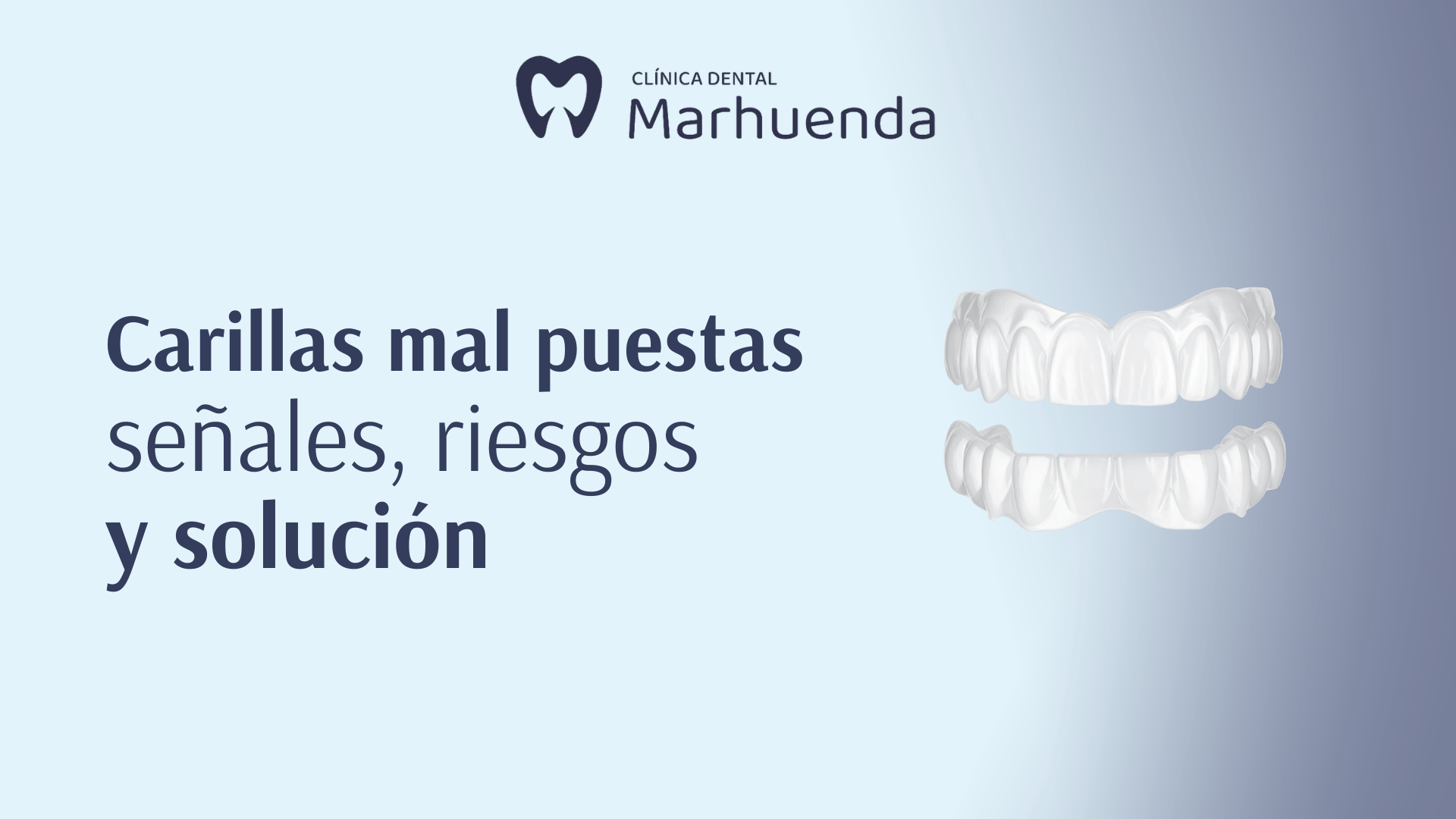 Carillas mal puestas: señales, riesgos y solución Carillas mal puestas: señales, riesgos y solución