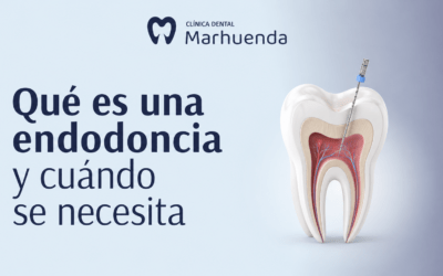 Qué es una endodoncia y cuándo se necesita