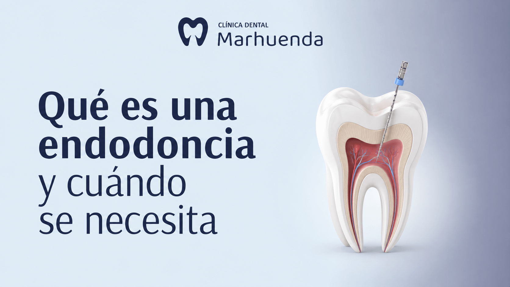 Qué es una endodoncia y cuándo se necesita