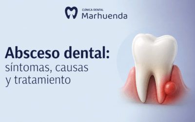 Absceso dental: síntomas, causas y tratamiento