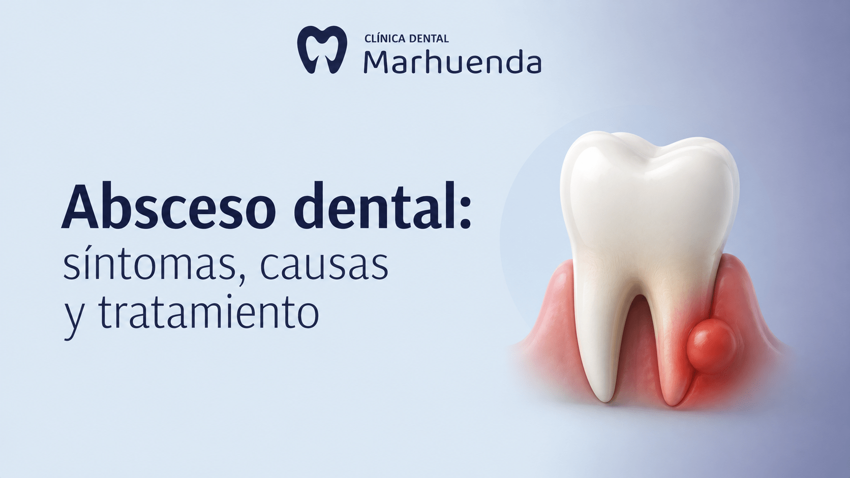 Absceso dental: síntomas, causas y tratamiento Absceso dental: síntomas, causas y tratamiento