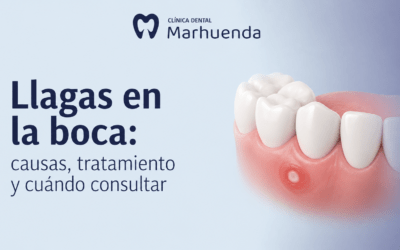 Llagas en la boca: causas, tratamiento y cuándo consultar