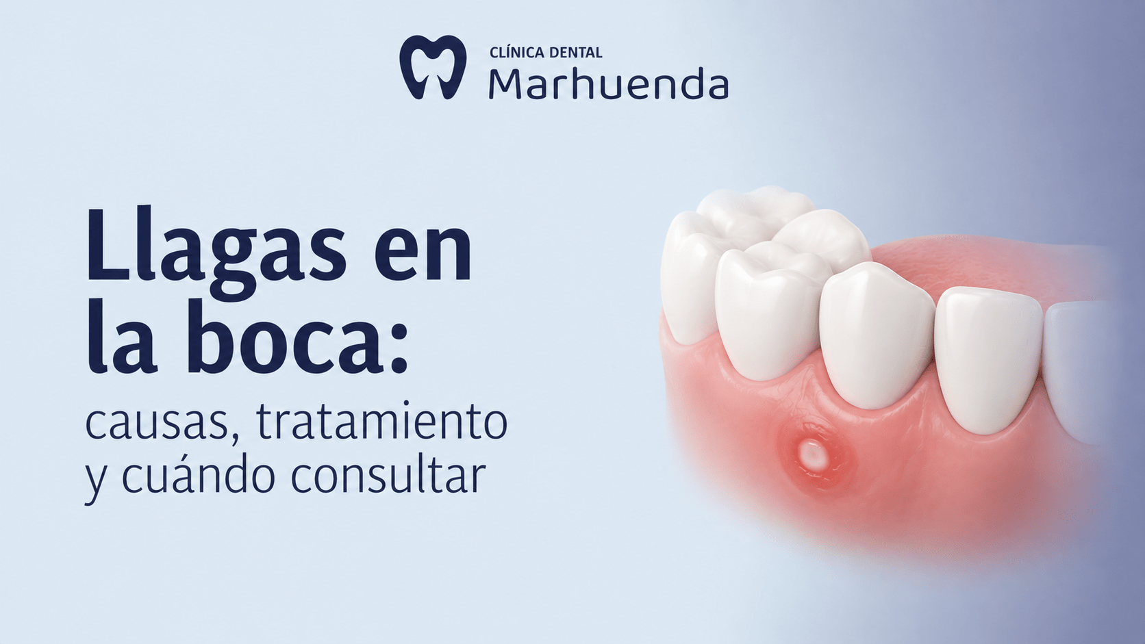 Llagas en la boca: causas, tratamiento y cuándo consultar
