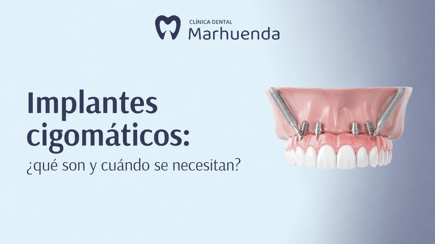 Implantes cigomáticos Implantes cigomáticos