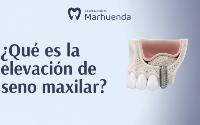 Qué es la elevación de seno maxilar