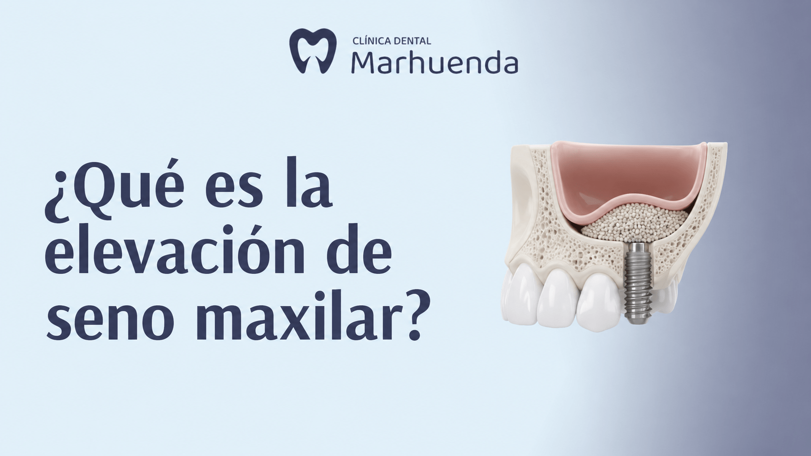 Qué es la elevación de seno maxilar Qué es la elevación de seno maxilar