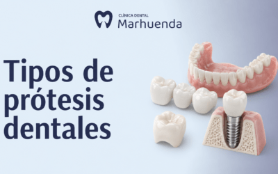Tipos de prótesis dentales: ¿cuál es la mejor para ti?