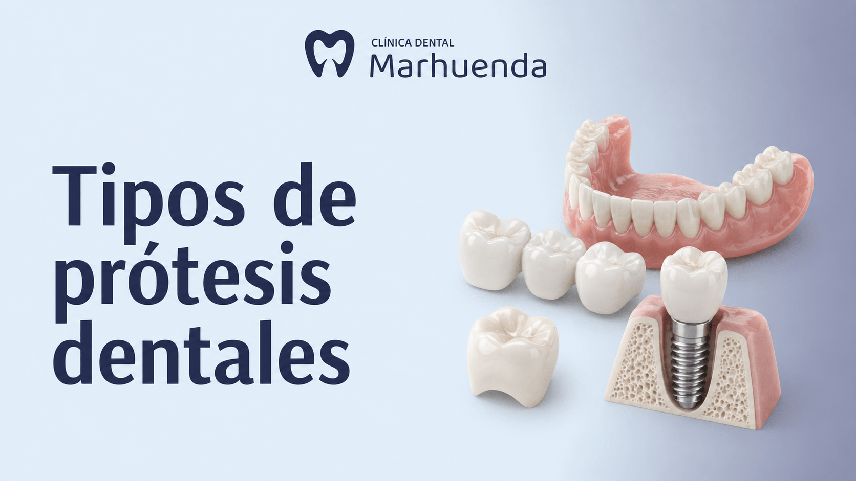 tipos de protesis dentales tipos de protesis dentales