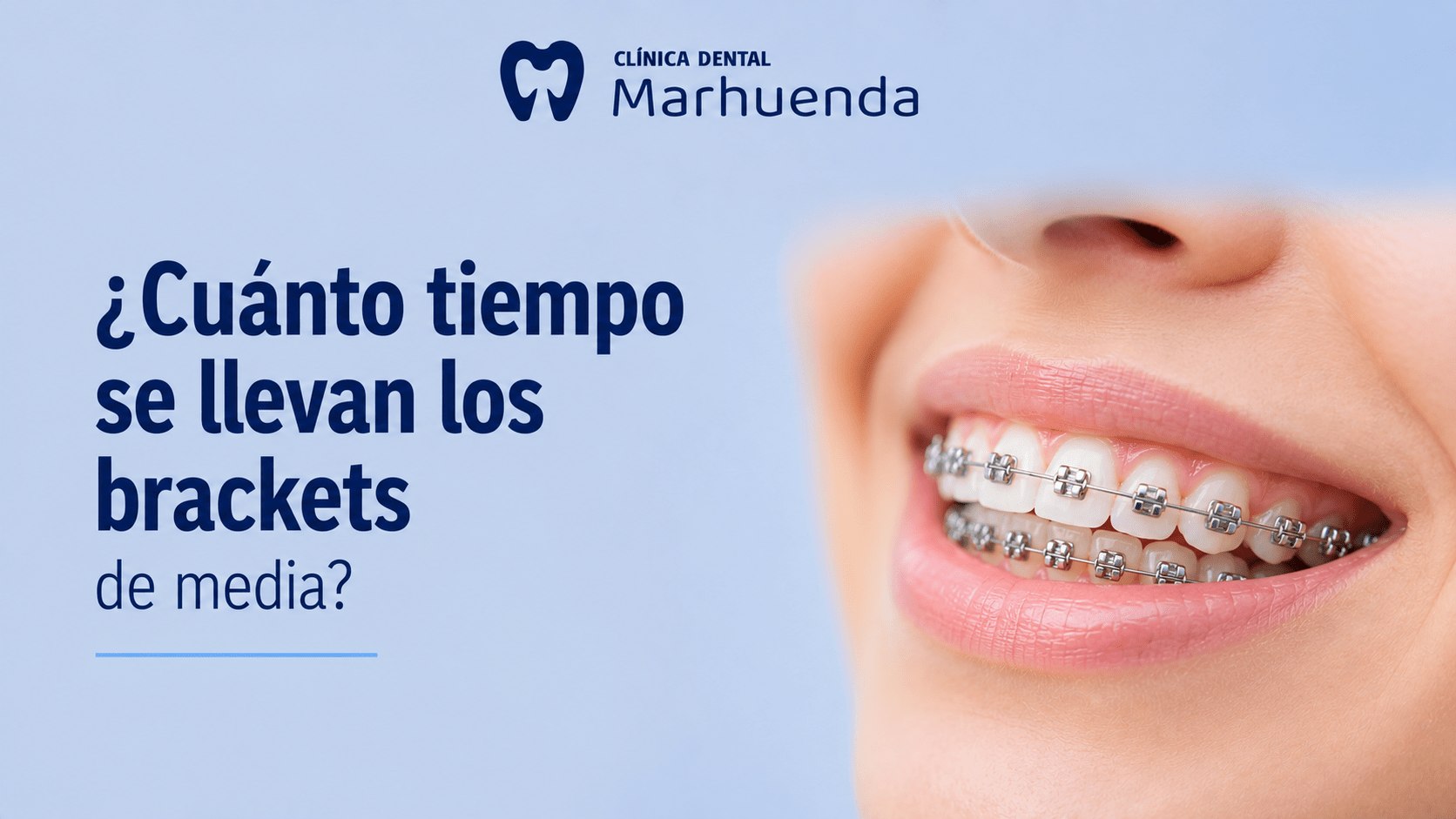 ¿Cuánto tiempo se llevan los brackets? ¿Cuánto tiempo se llevan los brackets?