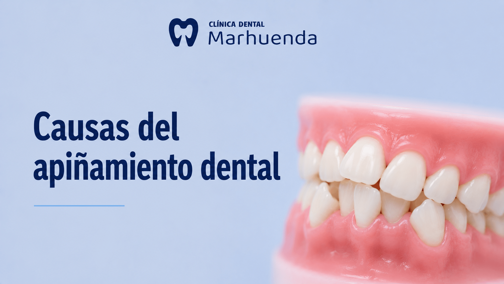 Causas del apiñamiento dental: por qué se tuercen los dientes